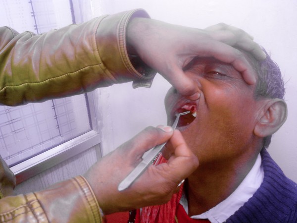 A gengiva do paciente Vijay Kumar depois que seu dente foi removido pelo dentista tradicional Rattan Singh na cidade norte indiana de Jammu, em 4 de Janeiro de 2015 (Venus Upadhayaya/Epoch Times)