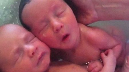 Após nascimento gêmeos continuam abraçados