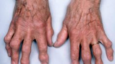 Pesquisadores estudam perfil genético de pessoas com artrose
