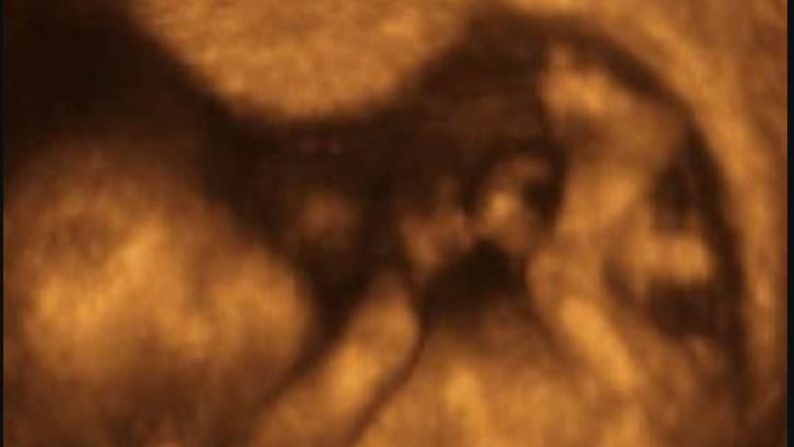 Ultra-som de um feto de 12 semanas de vida (Wikimedia)