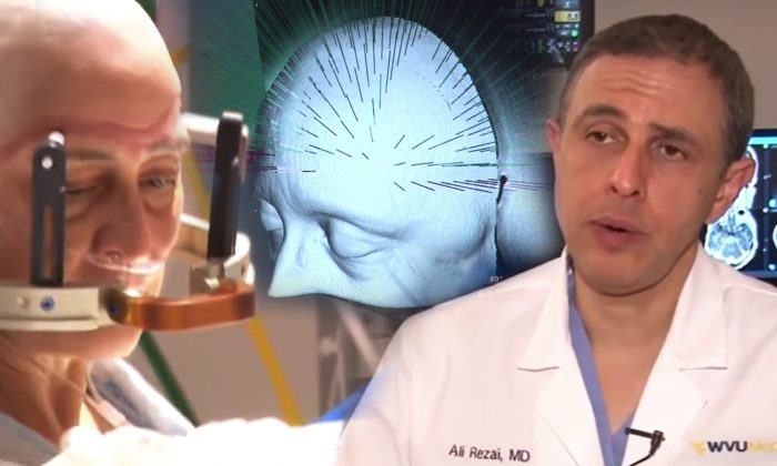 Médicos realizam a primeira terapia ultra-sônica do mundo para tratar a doença de Alzheimer
