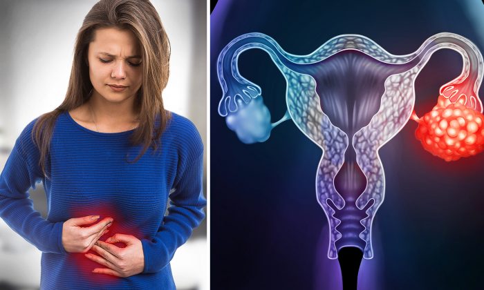 Cinco sinais que podem significar câncer de ovário – os estágios iniciais são difíceis de detectar