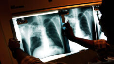 Pandemia reduz avanços no combate à tuberculose, diz especialista