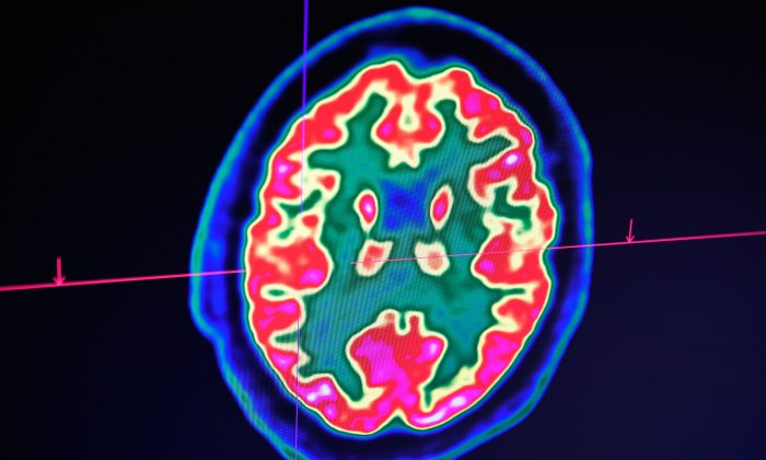 Cientistas afirmam que podem ter descoberto causa da Alzheimer