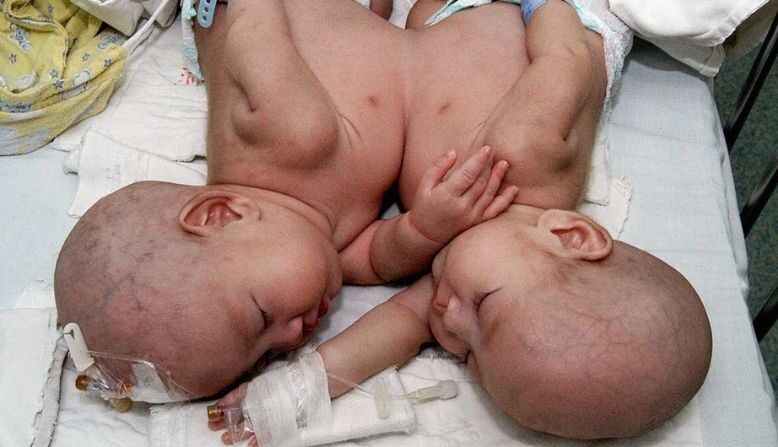 Gêmeas unidas pelo abdômen foram separadas em cirurgia bem-sucedida: ‘milagroso e incrível’
