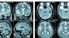 Lesões cerebrais após vacinação contra COVID