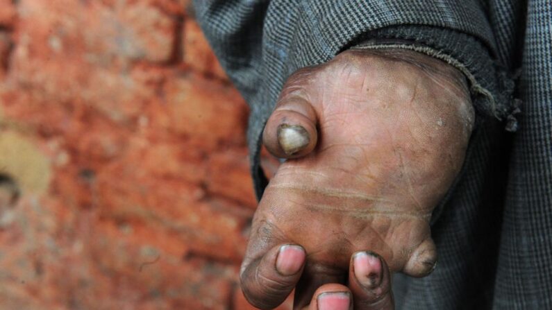 Um paciente com hanseníase estende a mão no hospital de hanseníase no centro de Srinagar em 30 de janeiro de 2017. O Dia Mundial da Hanseníase é comemorado em 30 de janeiro para aumentar a conscientização pública sobre a doença (Foto de TAUSEEF MUSTAFA / AFP via Getty Images)