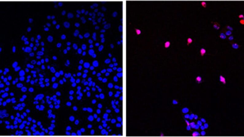 A pequena molécula AOH1996, desenvolvida pela City of Hope, tem como alvo uma variante cancerígena da proteína PCNA. A imagem mostra células cancerígenas não tratadas (esquerda) e células cancerígenas tratadas com AOH1996 (direita) passando por morte celular programada (violeta) (Cortesia de City of Hope)