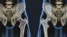 Por que você deve evitar medicamentos para osteoporose