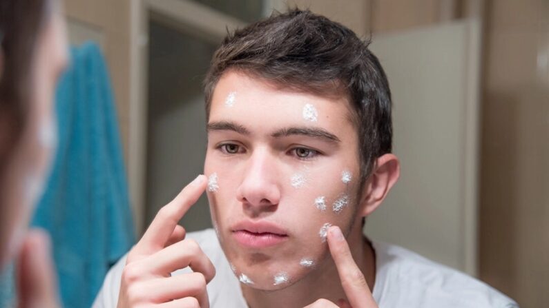 Homem jovem aplicando creme para acne no rosto (shutterstock)