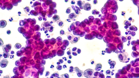 As proteínas spike da COVID ajudam as células do câncer a sobreviver e resistir à quimioterapia, segundo estudo pré-impresso da Brown University