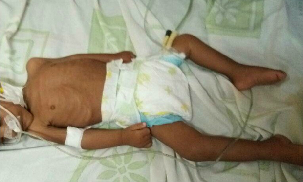 Última vítima da desnutrição infantil. Menina de um ano e meio (imagem da TV VPI)