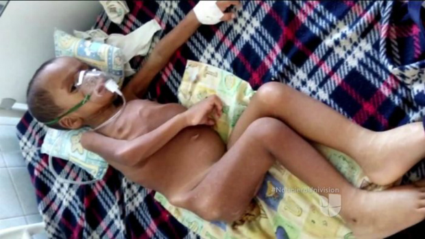 Sobe número de morte de crianças por desnutrição na Venezuela (Captura de tela)