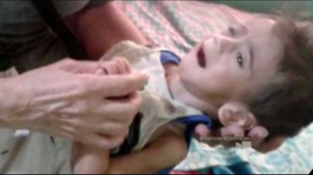 Sobe número de morte de crianças por desnutrição na Venezuela (Captura de Video)