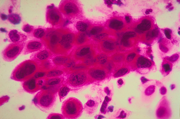 vacina, câncer, tumor, cura, saúde, células T - Uma imagem ampliada de células cancerígenas no colo do útero (Sociedade Americana do Câncer/Getty Images)